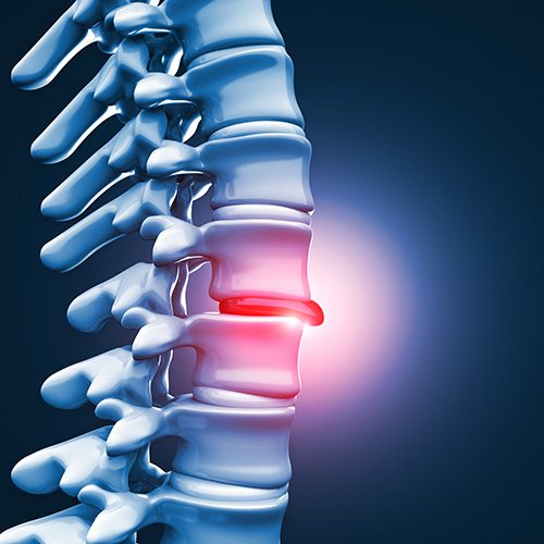 3d Disc - Spinal Decompression - Village Family Clinic 3d Disc - Spinal Decompression - Village Family CLinic